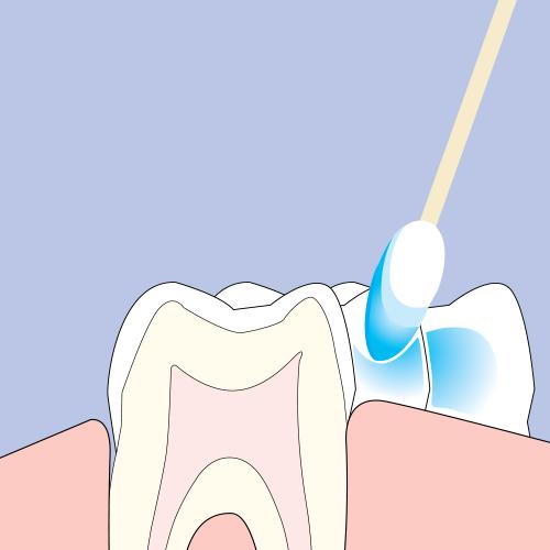 Zarosen Desensitizing Cavity Varnish and Dentinal Tubuli Seal