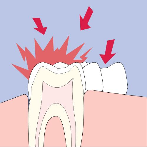 Varnal Cavity Varnish